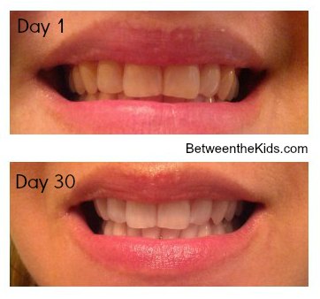 smile brilliant led teeth whitening system